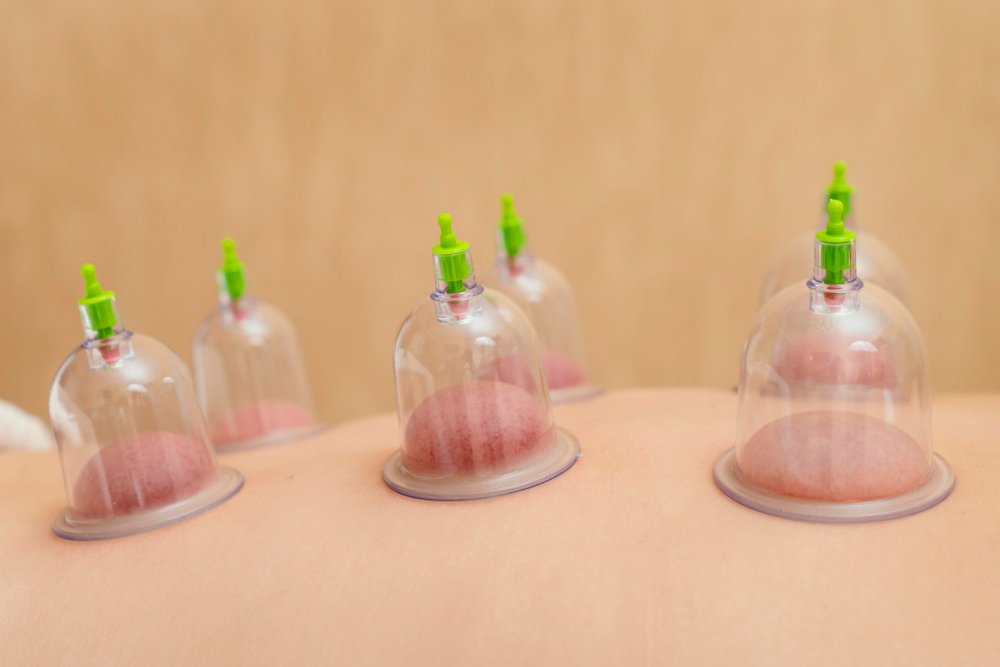 Close Up Patient Experiencing Cupping Therapy (2)