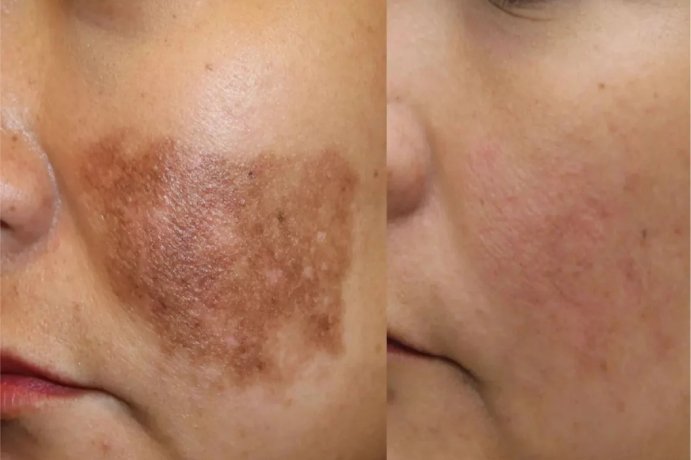 Pigmentation