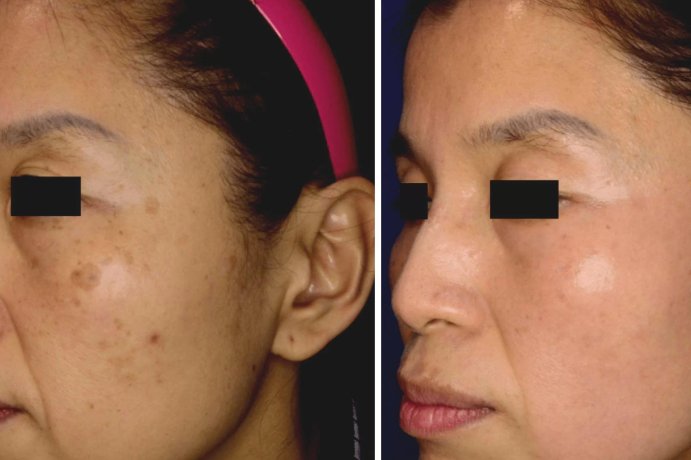 Picosure