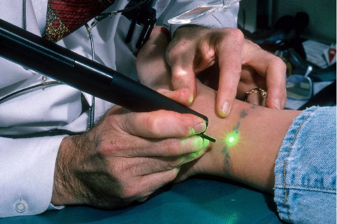 Tatoo Removal